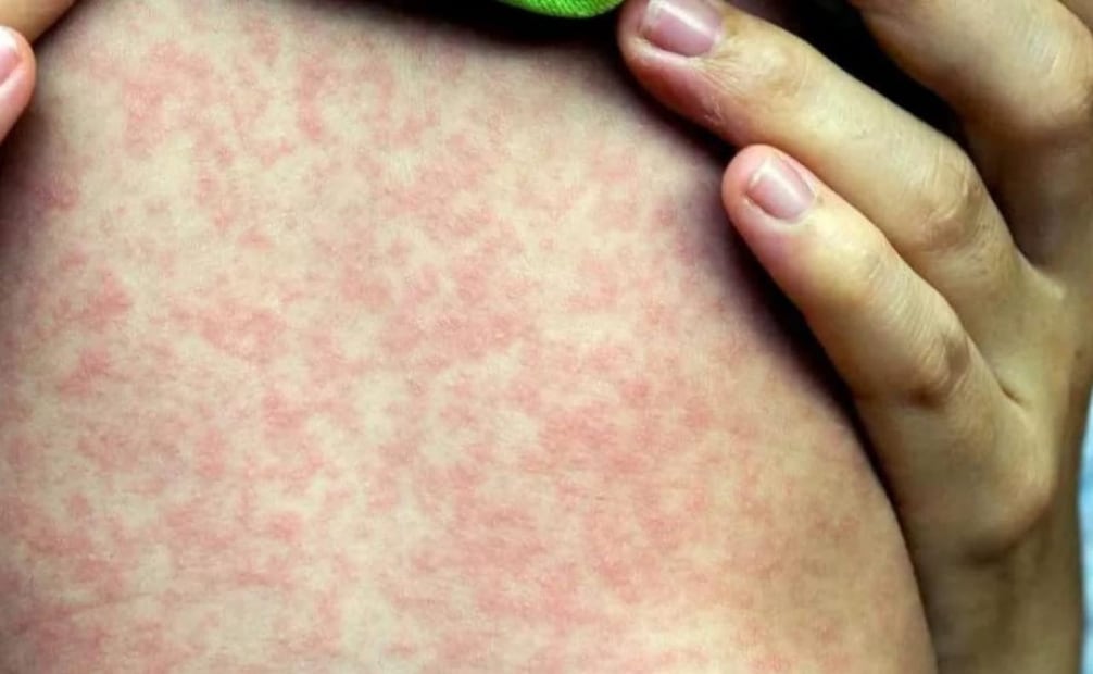 Yucatán ocupa en lugar 28 en tabla nacional de contagios de sarampión; hay 10 casos confirmados.
Foto: Especial.