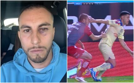 Alejandro Mayorga muestra cómo le quedó el ojo tras el manotazo de Richard Sánchez