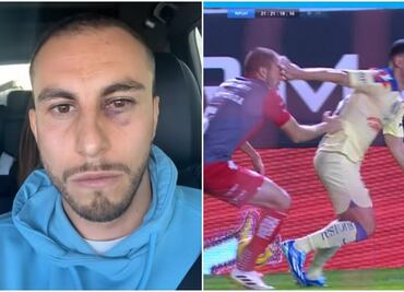 Alejandro Mayorga muestra cómo le quedó el ojo tras el manotazo de Richard Sánchez