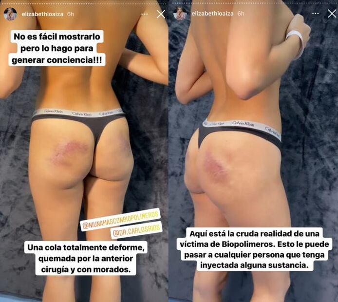 Modelo muestra sus glúteos destrozados por una mala cirugía